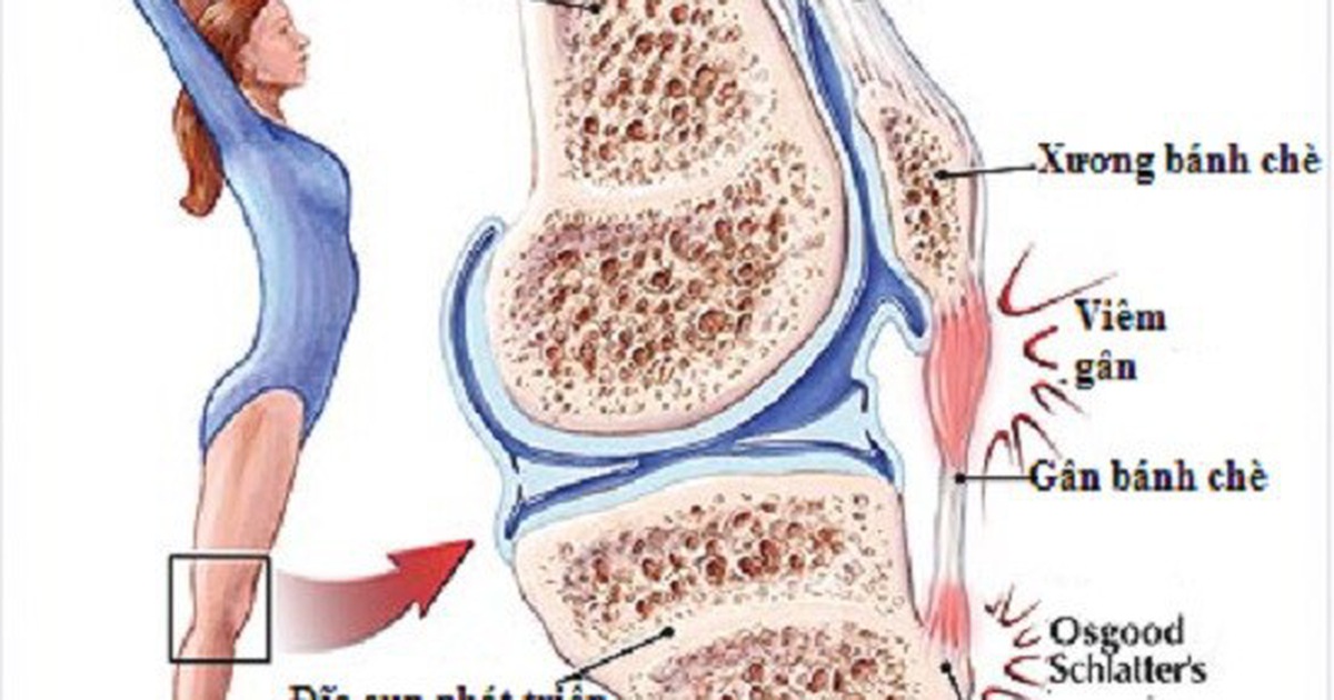 Viêm gân xương bánh chè - Hình ảnh minh họa